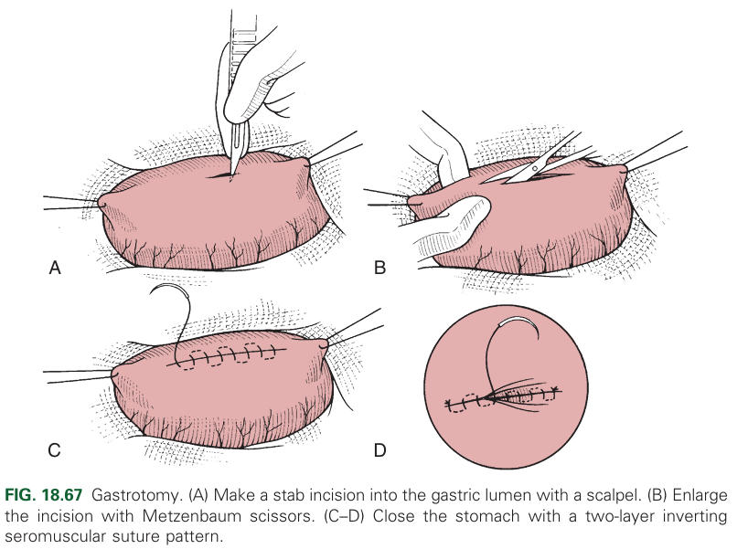 Incision through the stomach wall into the lumen.
