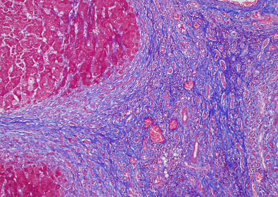 <p>Special stain for cirrhosis </p>