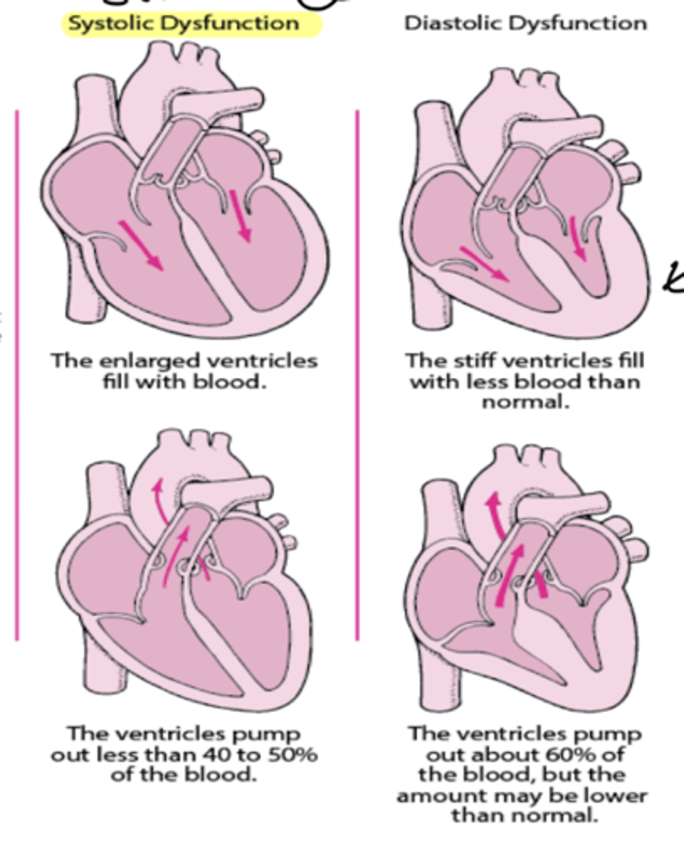 <p>systolic - stretched cells - causing a weaker contraction so ventricles pump out less than 40-50% of blood</p><p>diastolic - no place to occupy blood due to hypertrophy - ventricles pump out 60% of blood still but amount may be lower</p>