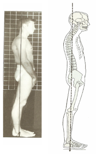 <p>Sway-back posture-1:</p>