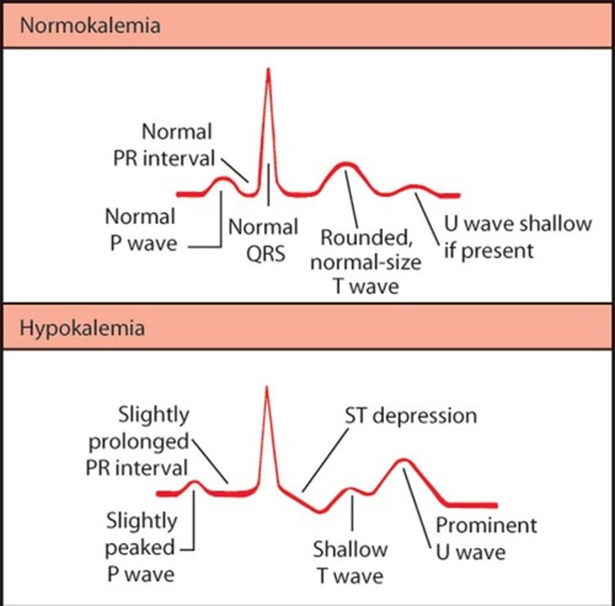 <p>Causes: Decreased intake (starvation), shift from ECF to ICF with increased renal loss, v/d. Manifestations: Decreased neuromuscular excitability, skeletal muscle weakness, smooth muscle atony, cardiac dysrhythmias (flattened/depressed T-wave, prominent U-wave).</p>