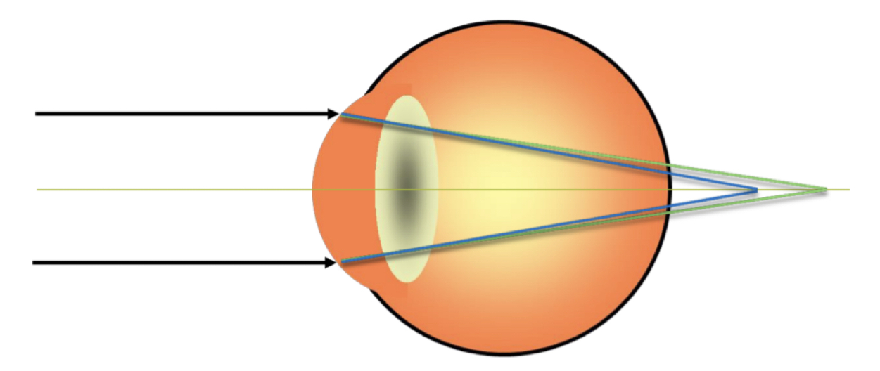 What type of astigmatism is this?