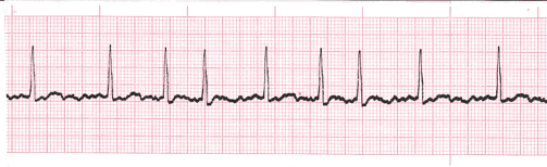 <p>atrial fibrilation</p>