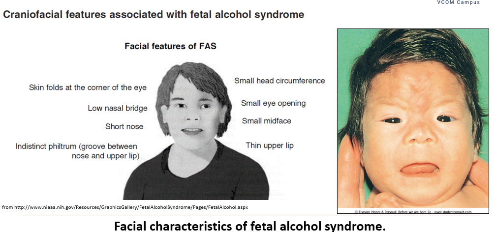 <ol><li><p class=""><strong>Fetal alcohol effects include </strong>behavioral and learning issues from <strong>moderate use</strong> or <strong>binge episodes</strong></p></li><li><p class=""><strong>Fetal alcohol syndrome</strong>: physical, mental, and growth anomalies from <strong>chronic alcoholism</strong></p></li></ol><p class=""></p><p class=""><strong>Abstinence</strong> from alcohol is <strong>recommended during pregnancy</strong></p>