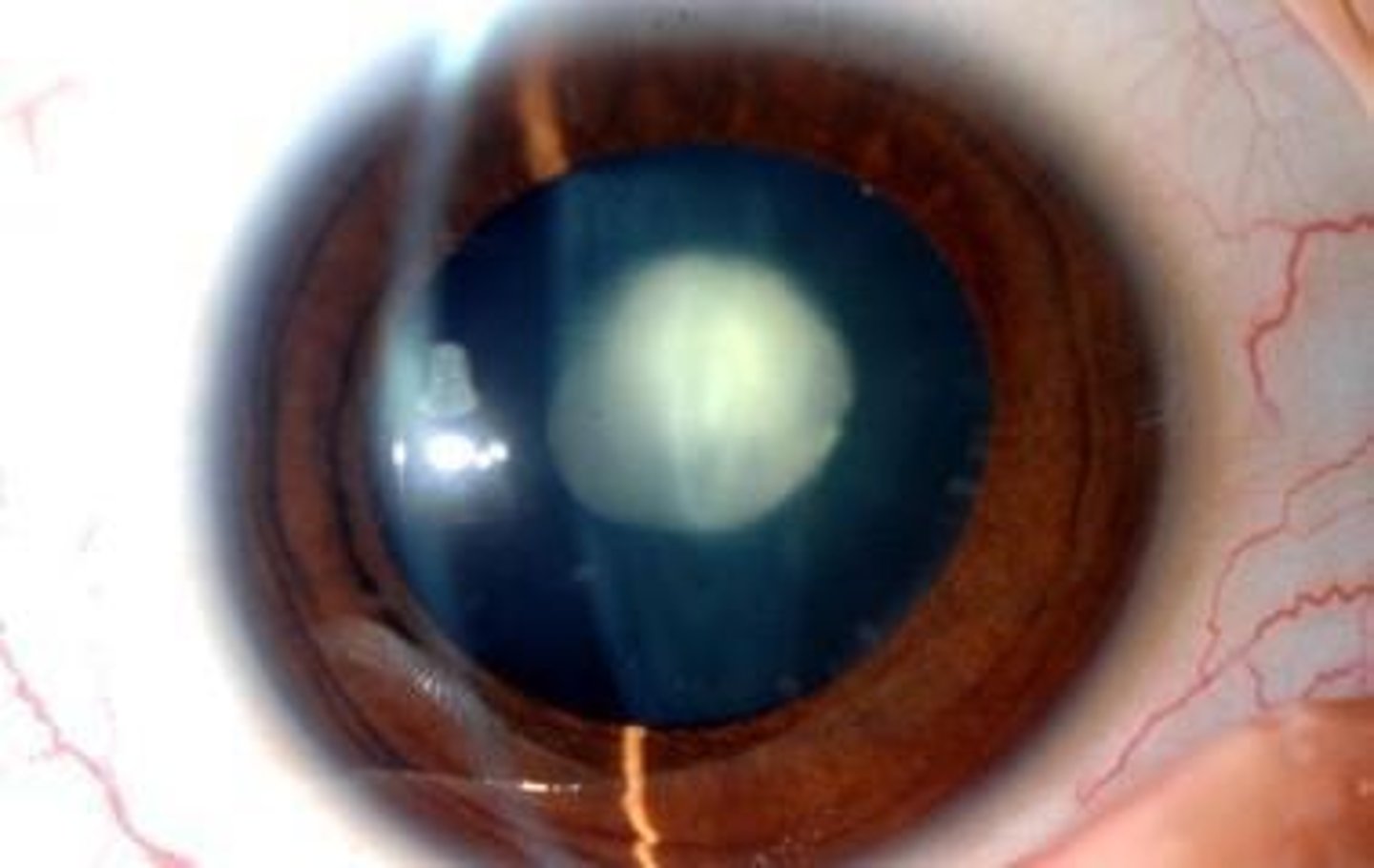 <p>A condition where the lens becomes cloudy, impairing vision, which is a hallmark of cataract formation.</p>