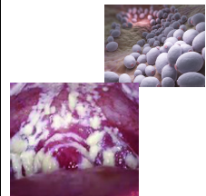 <p>a <strong>thick, cheesy exudates (milk curd-like appearance</strong>) vaginal discharge</p>