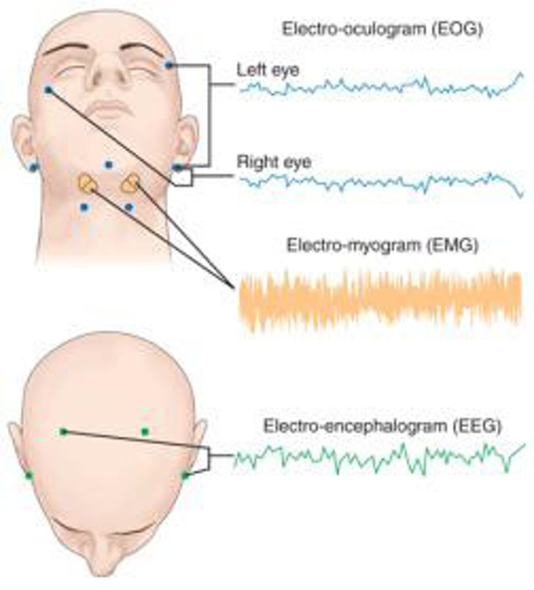 <p>#1: polysomnography: multi-parameter sleep test</p><p>actigraphy: at home device (watch) that estimates sleep stages</p><p>- variable reliability</p>