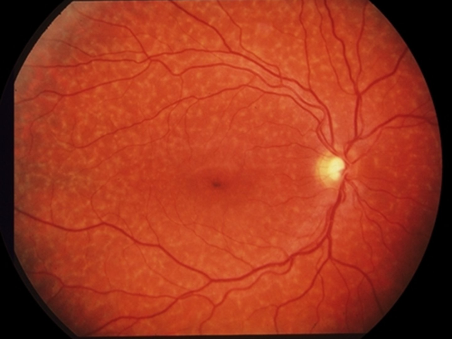 <p>condition that has...</p><p>later onset of the disease</p><p>slower detiorioration of vision</p><p>more widespread retinal involvment</p><p>macula less involved = better VA</p>