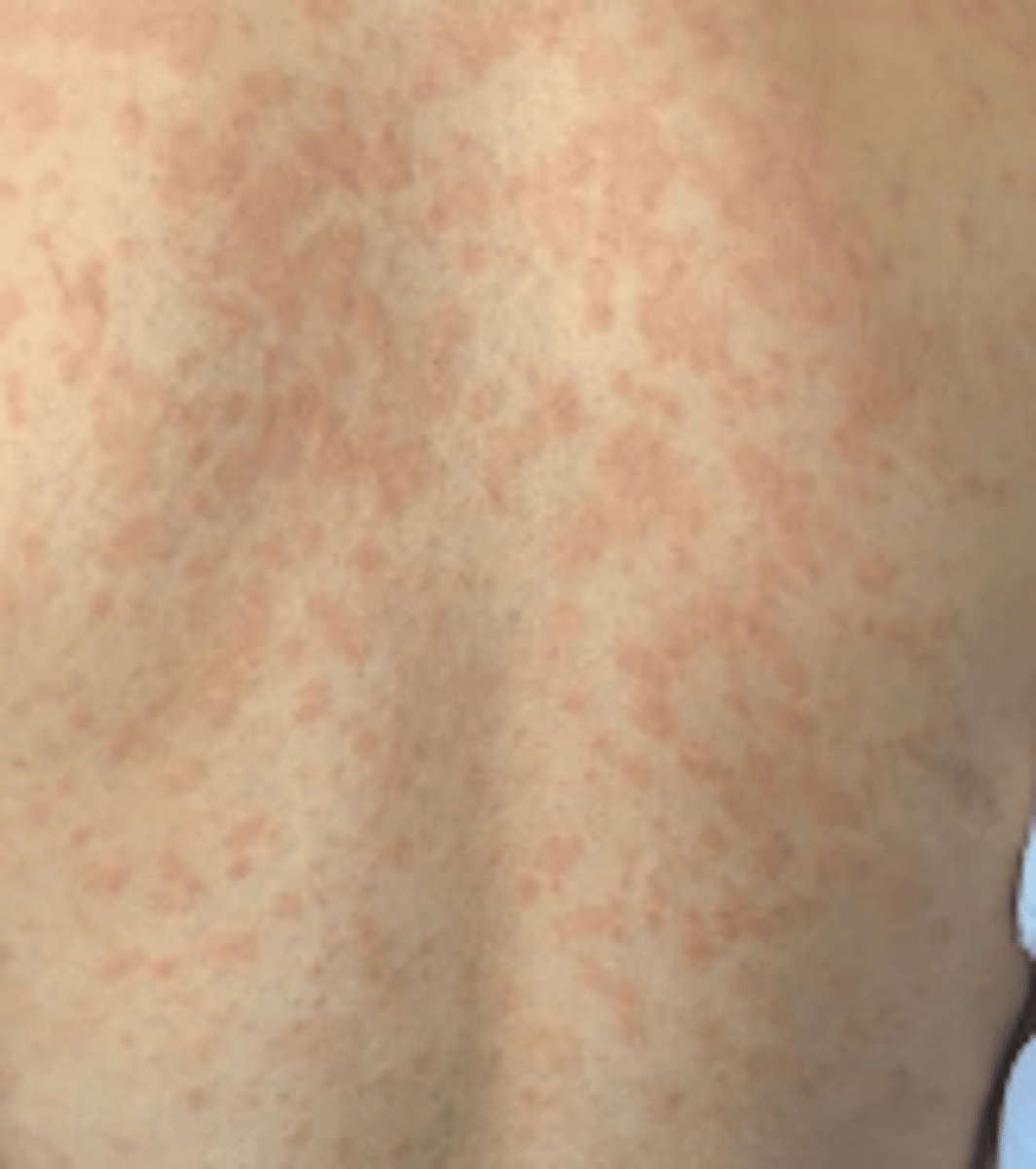 <p>herald patch (single patDch)</p><p>--&gt;</p><p>pink papules on trunk (xmas tree)</p>
