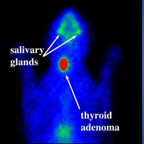 <p>describe the scintigraphy </p>