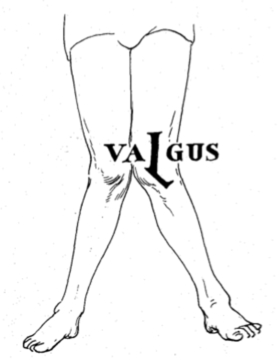 <p>- knock knees</p><p>- greater than 185 degrees</p>