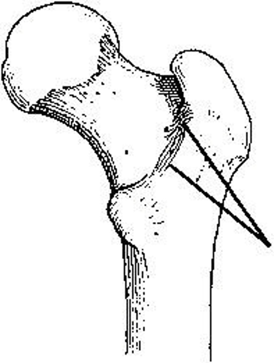 <p>The area identified on the bone shown in the figure above is the:</p><p>posterior inferior spine</p><p>lesser trochanter</p><p>greater trochanter</p><p>intertrochanteric crest</p>