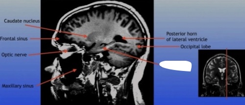 <p>A critical region in the brain associated with memory formation and spatial navigation, located in the medial temporal lobe. </p>