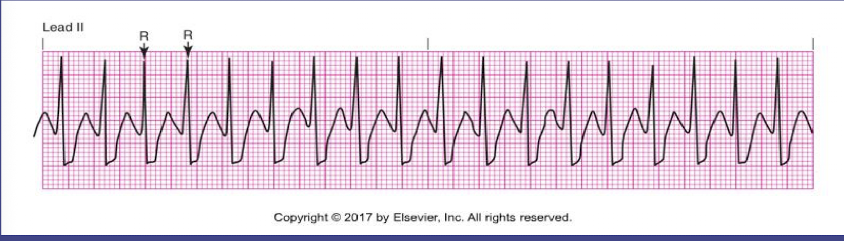 <ol><li><p>rate: 100-250 bpm</p></li></ol><ol><li><p>rhythm: regular; R-R are consistent</p></li><li><p>P waves: may not be able to visualize P waves as they are often hidden in the preceding T wave due to the fast rate</p></li><li><p>PR interval: may not be able to measure, depending on whether you can see the P wave</p></li><li><p>QRS interval: usually narrow but still within 0.06-0.10</p></li></ol><p></p>