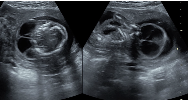 <p>cystic hygroma = abnormal accumulation of lymphatic fluid under the skin</p><p>.</p><p>if an <strong>isolated</strong> cystic hygroma is present, AFP levels will be ____</p><p>.</p><p>if cystic hygroma is present <strong>w/Turner syndrome,</strong> AFP levels will be ___</p><p>.</p><p>a) decreased, increased</p><p>b) normal, decreased</p><p>c) normal, increased</p><p>d) increased, decreased</p>