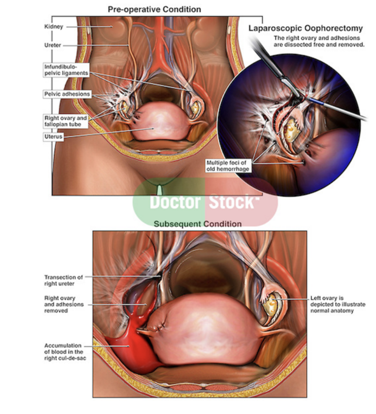 <ul><li><p>Surgical removal of 1 or both ovaries — can be done laparoscopically (tube camera) unless otherwise indicated</p></li><li><p>May be performed for ovarian pathology (ex. neoplasm), risk-reducing purposes (reducing risk of reoperation or cancer), or fertility preservation </p></li><li><p>In children &amp; adolescents specifically — ovarian sparing surgery is a viable approach in most cases of torsion &amp; benign ovarian masses —</p><ul><li><p>Ovaries are responsible for sex hormone synthesis — thus risk of bilateral oophorectomy must be weighed against the benefits — reviewing anatomy &amp; physiology of ovaries, indications &amp; techniques for oophorectomy, &amp; complications for gynecologic adnexal surgery </p></li></ul></li></ul>