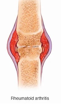 <p>Joints become red,warm, swollen, and painful</p>