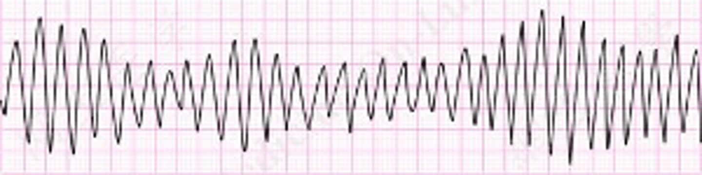 <p>SVTs more likely to cause pre-syncope &amp; palpitations</p><p>Ventricular arrhythmias:</p><p>•Ventr. Tachycardia</p><p>•Torsades de pointes</p><p>•Ventr. Fibrillation</p><p>•Long Q-T syndrome</p><p>•Brugada syndrome&nbsp;</p>