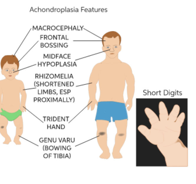 <ul><li><p><span style="background-color: transparent; font-family: "Proxima Nova", sans-serif;"><span>Ex. dwarfism (achondroplasia)</span></span></p></li><li><p><span style="background-color: transparent; font-family: "Proxima Nova", sans-serif;"><span>Ex. gigantism (acromegaly)</span></span></p></li></ul><p></p>