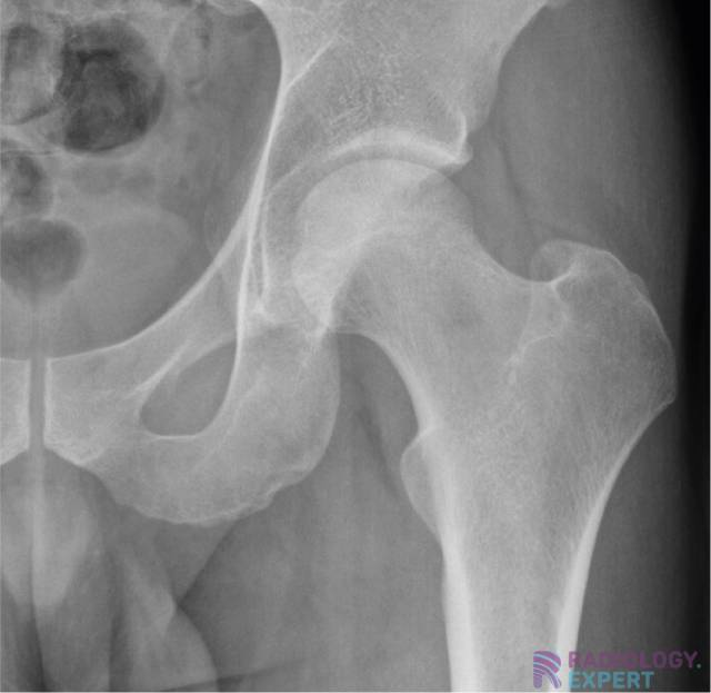 <p>ASIS (do not include top of ilium)</p>