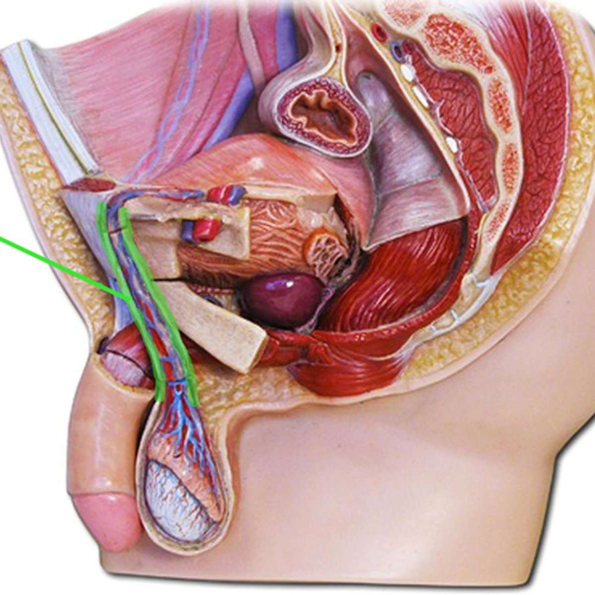 <p>inguinal canal to the scrotum and contents disperse around testes and scrotum</p>