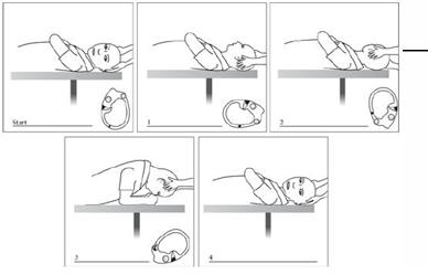 <p>Located in the horizontal canal</p><ol><li><p>In supine with 30deg flexion, head turned 45deg toward <strong>affected </strong>ear and<u> held for about 1 minute</u></p></li><li><p>Head rolled slowly back to neutral, pause for 1 minute</p></li><li><p>Continue toward unaffected ear and stop at 45deg. <u>Hold for about 1 minute</u></p></li><li><p>Roll in same direction until patient is prone resting on elbow, chin tucked towards chest.<u> Hold for 1 minute.</u></p></li><li><p>Return patient back to supine, and then sitting</p></li></ol><p></p>