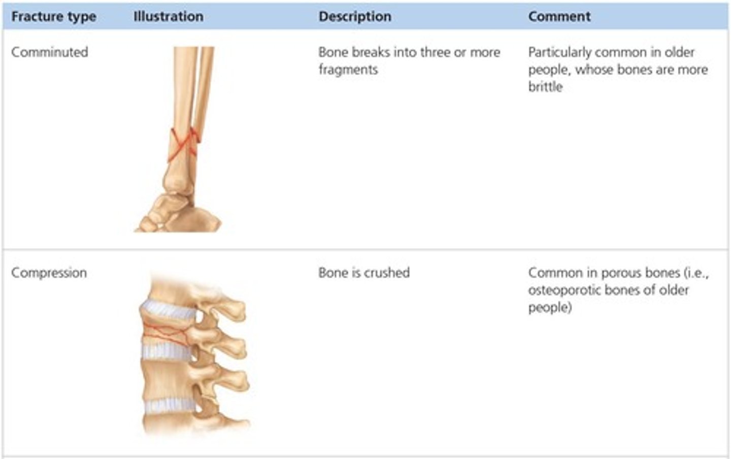 <p>A break in a bone.</p>