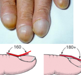 <p>enlargement and rounding of the fingertips and nails.</p>