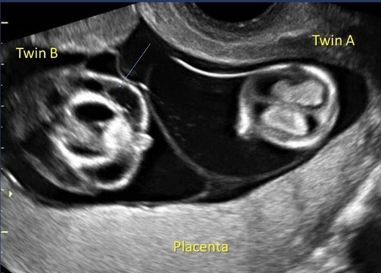 <p>Amniotic fluid discrepancy</p><p>Absent bladder in donor twin</p><p>ABNL umbilical artery S/D ratio in donor twin</p><p>Ductus venosus flow reversal in recipient twin</p><p>Hydrops in recipient twin</p>