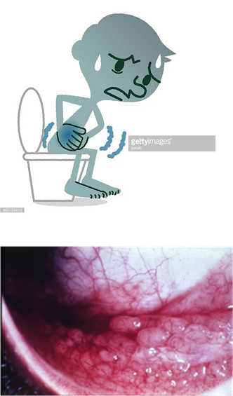 <p><strong>Gastroenteritis </strong>– It is the s<strong>econd most common cause </strong>of diarrhea in infants and young children, caused by adenovirus serotypes 40, 41, and 42.</p>