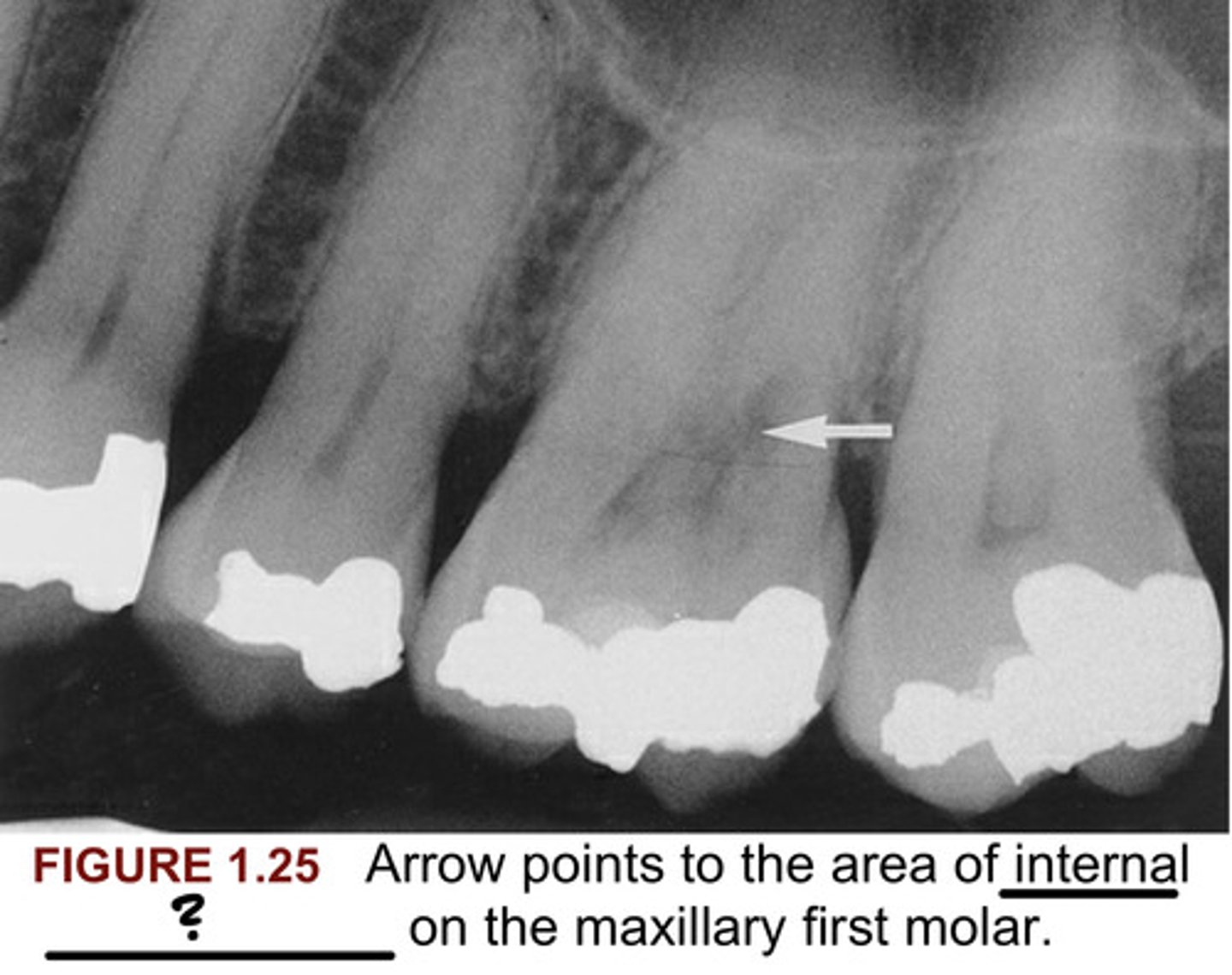 <p>The arrow in Figure 1.25 points to the area of internal what on the maxillary first molar?</p>
