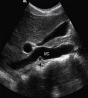 <p>The RRA is the only vessel that travels laterally ___ the IVC</p>