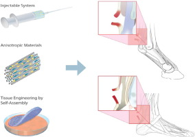 <ol><li><p>Scaffold: u<span>rinary bladder matrix (Basically a graft sewn on the ruptured tendon - like a skeleton for the cells to be healed. The scar tissue usually formed has less elasticity – this scaffold improves the scar tissue quality).</span></p></li><li><p><span>Growth factors: platelet-rich plasma (PRP) injected intra-tendon with USG control.</span></p></li><li><p><span>Stem cell therapy: from bone marrow. Impractical.</span></p></li></ol><p></p>