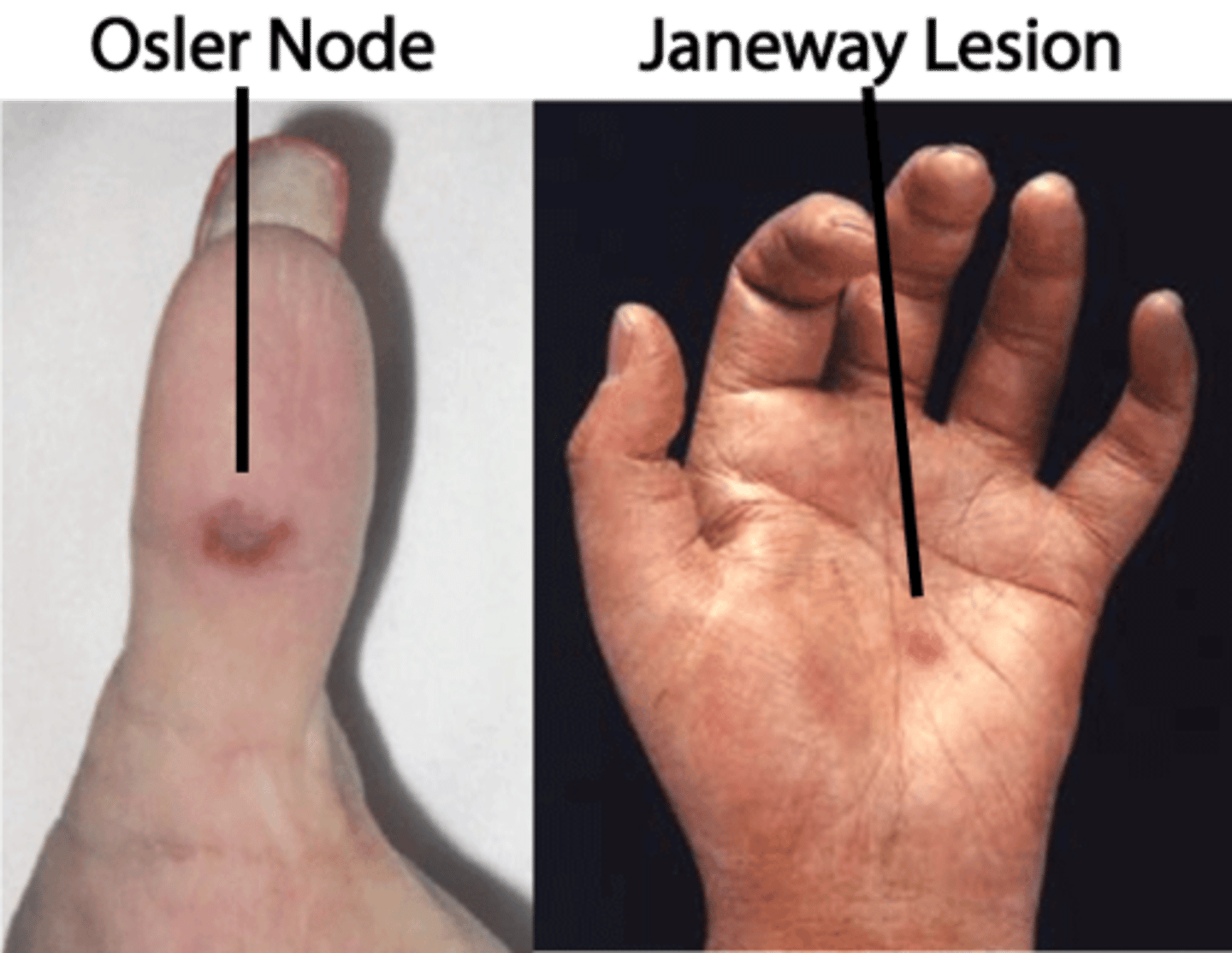 <p>1) Osler Nodes (painful, on fingers/toes)</p><p>2) Janeway Lesions (painless, on soles/palms)</p><p>3) Petechiae-palate</p>