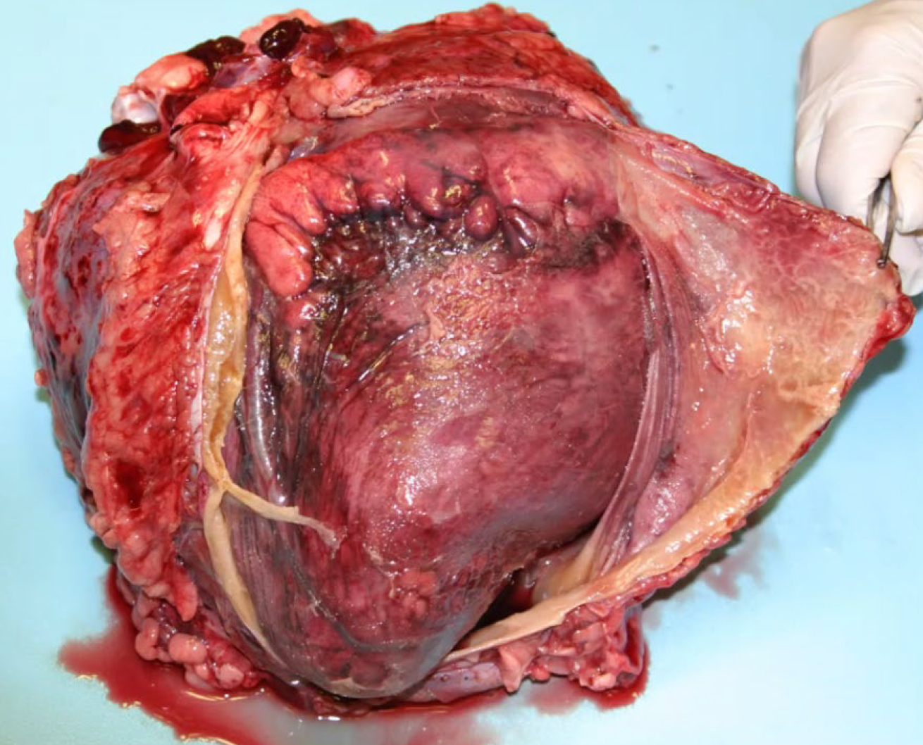 <p>What is the etiology?</p><p>A-Clostridium perfringens</p><p>B-Clostridium chauvoei</p><p>C-Clostridium septicum</p><p>D-Clostridium novyi</p>