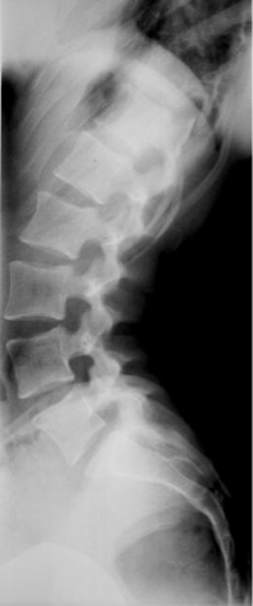 <p>ID lumbar lordosis</p>