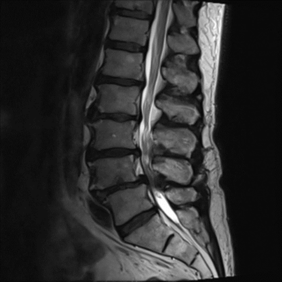 <p>narrowing of the spinal canal or neural foramina, caused by soft tissue and bony abnormalities, congenital or acquired</p><p>MRI is study of choice</p>