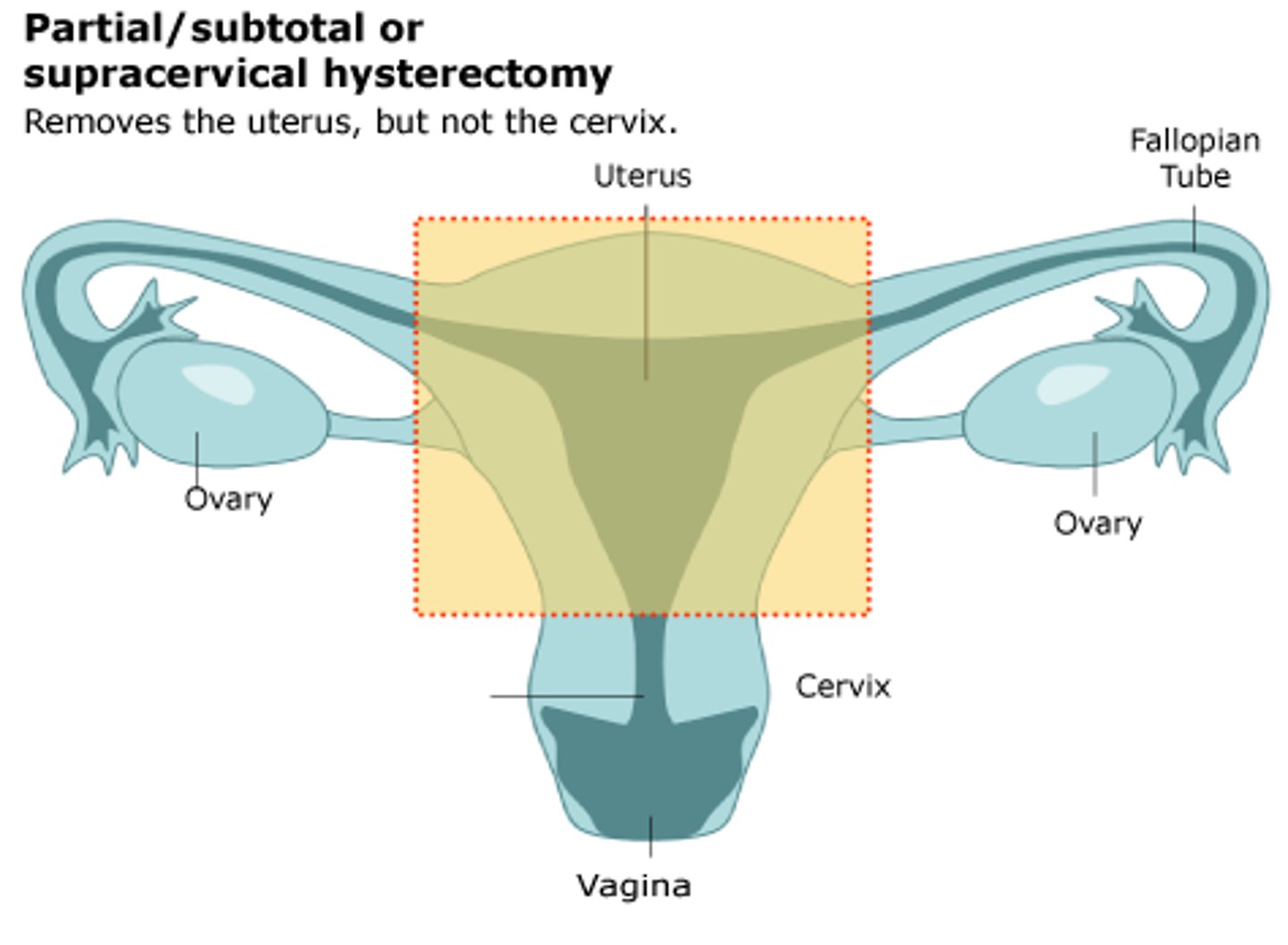 <p>removal of uterus</p>