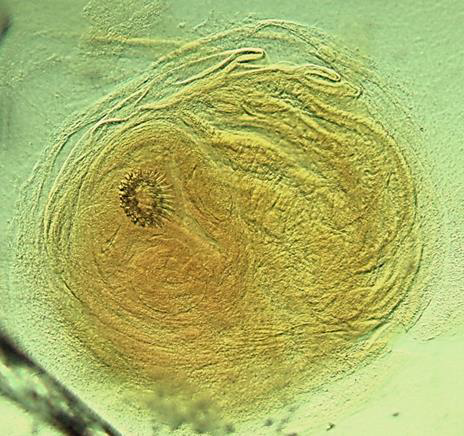 <p><strong>Identify this parasitic stage, its adult parasite, and mention the type of brain lesion it produces.</strong></p><ul><li><p><em>Cysticercus cellulosae</em></p></li><li><p>Adult parasite: <em>Taenia solium</em></p></li><li><p>Brain lesion: <strong>Cystic lesion (cysticercosis)</strong></p></li></ul><p><strong>What is the definitive diagnostic technique?</strong></p><ul><li><p><strong>Excision biopsy</strong></p></li></ul><p><strong>Mention two morphological characteristics of this stage.</strong></p><ul><li><p>About <strong>5 × 10 mm</strong>, bladder-like (contains fluid)</p></li><li><p><strong>Scolex invaginated</strong> with 4 suckers and double rows of hooks</p></li></ul><p></p>