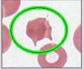 <p>impalement of RBC on fibrin strand</p>