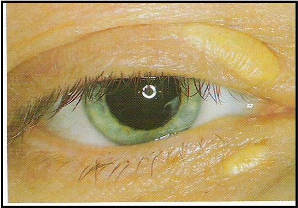 <p>yellow plaque or patch on eyelid or periorbital skin </p>