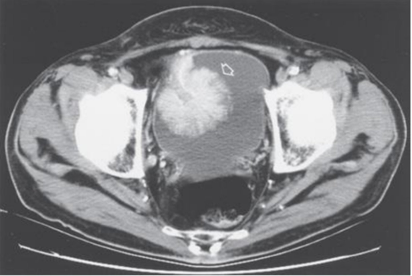 <p>UA (looking for hematuria), urine cytology (not sensitive, very specific tho), CT abdomen &amp; pelvis w/ &amp; w/o contrast plus delayed imaging (most sensitive), IVP or retrograde pyelogram (safe for patients w/ IV contrast allergies), cystoscopy w/ biopsy is definitive (gold-standard)</p>