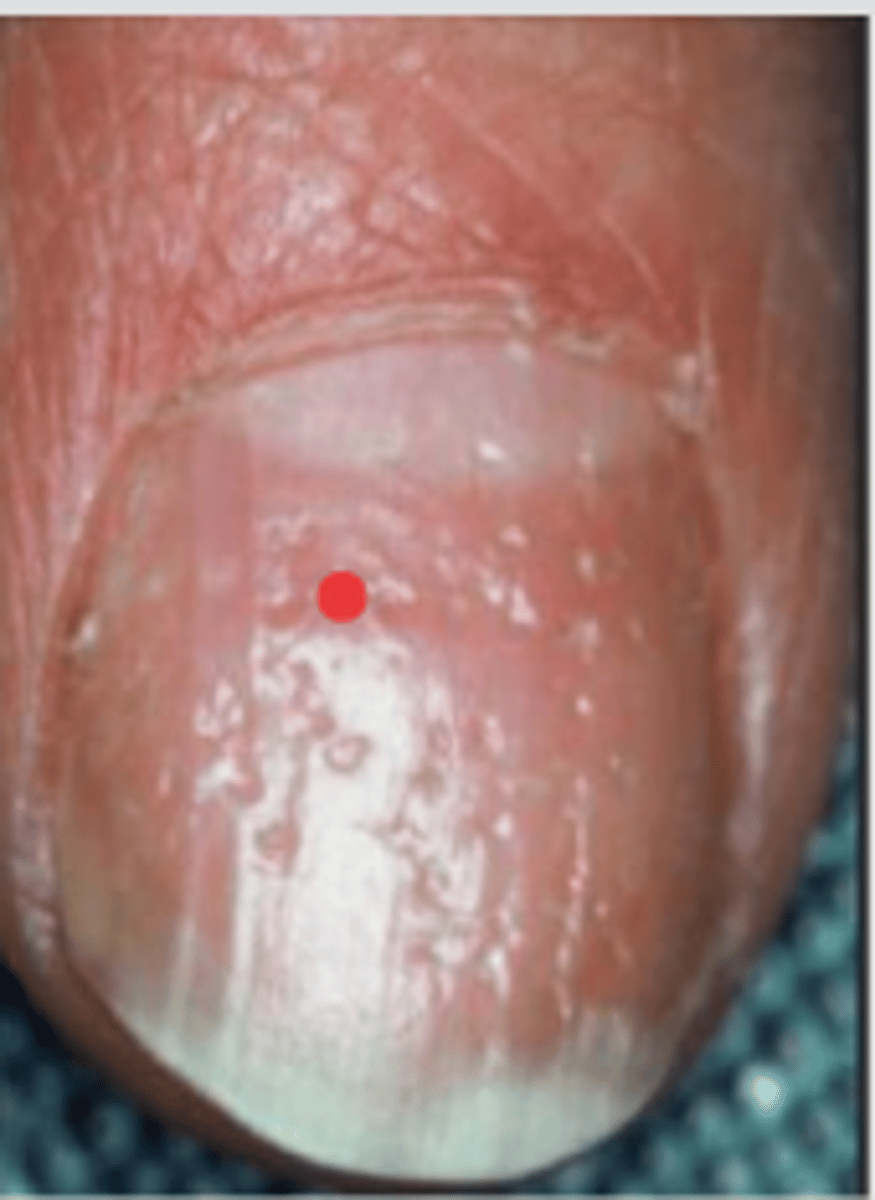 <p>Plaque psoriasis</p>