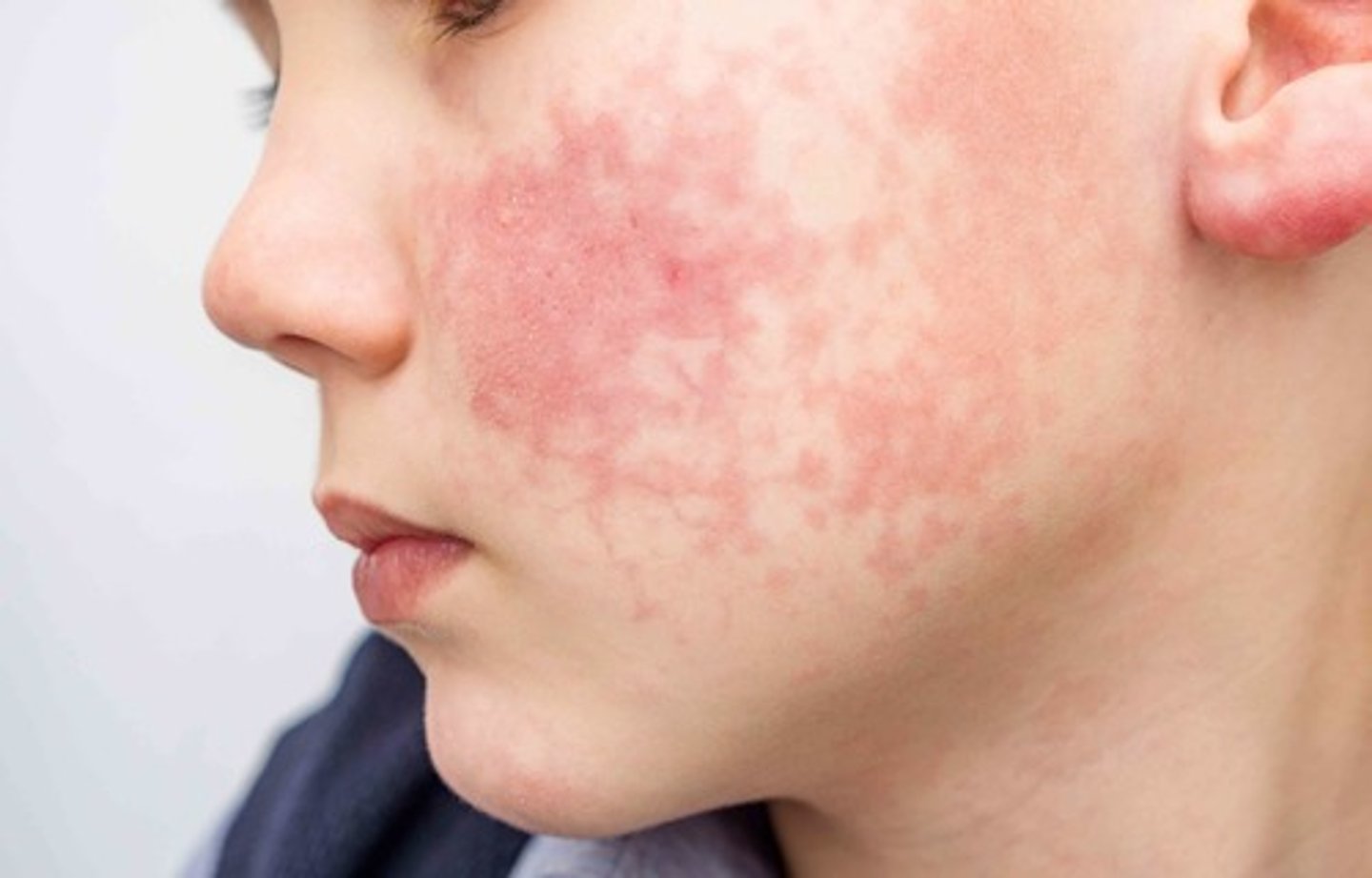 <p>Stage 1: Mild flulike symptoms</p><p>Stage 2: Slapped-cheek facial rash</p><p>Stage 3: Body rash</p><p>Only contagious BEFORE rash appears, cannot spread when rash present</p><p>Parvovirus b19</p><p>Droplet Precautions</p>