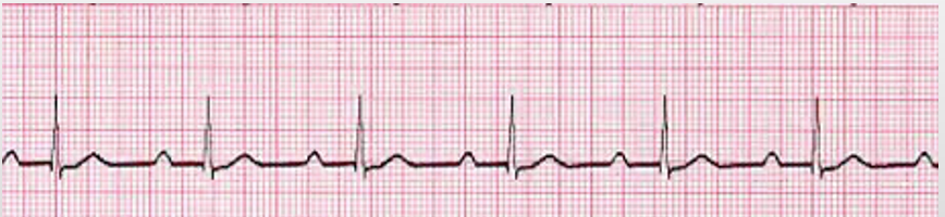 <p>RRR, long PR interval (&gt;0.2 sec)</p>
