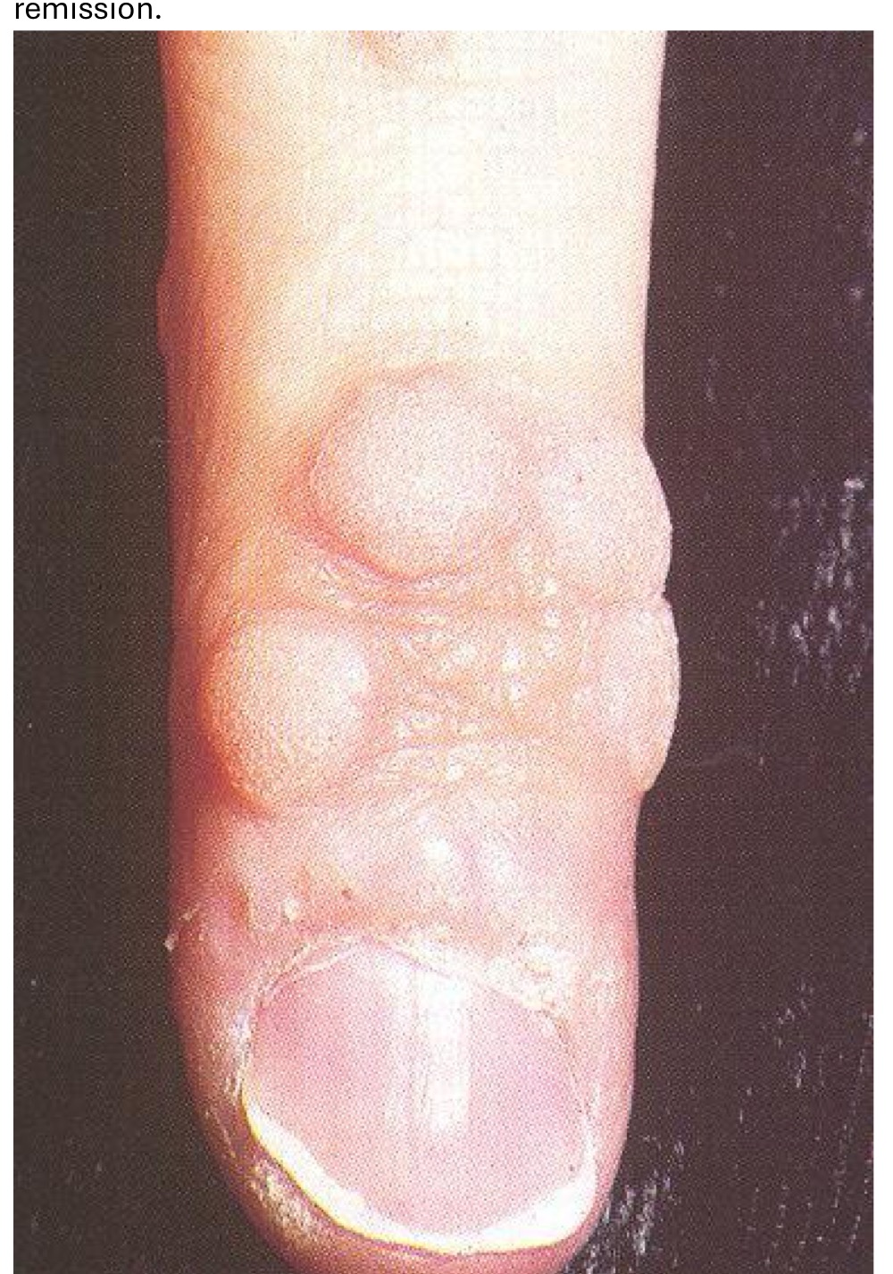 <p>where on the body is this viral infection commonly found </p>
