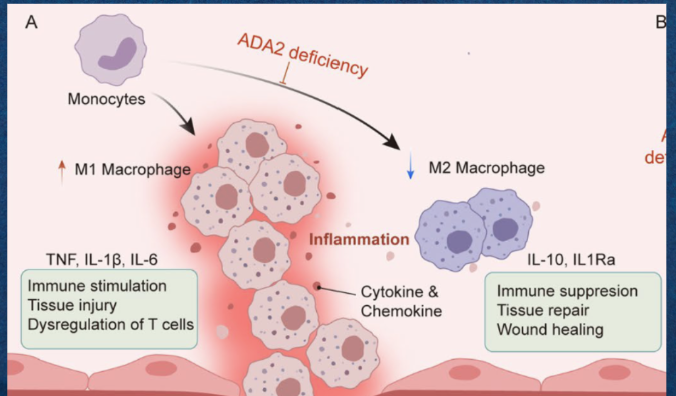<p>An increase in M1 macrophages (proinflammatory responses) and elevated inflammation.</p>