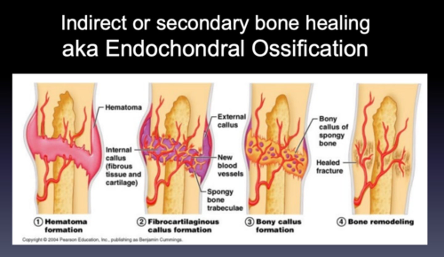 <p>Endochondral ossification</p><p>The repair process that is characterized by the formation of fracture callus, which then remodels to form new bone</p>