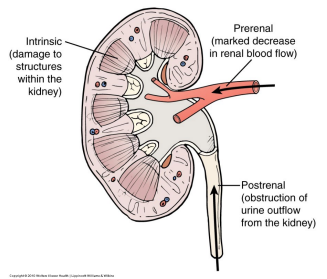 <ul><li><p>Occurs in ~10% of hospitalized patients and 50% of patients in the ICU, with mortality rate ~40 – 75%</p></li><li><p><strong>Abrupt decrease in renal function characterized by </strong><span style="color: red;"><strong><u>decreased GFR</u></strong></span></p></li></ul><p></p>