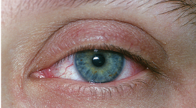 <p>Pink eye. Infection of conjunctiva. </p>